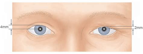 It results in weakness of the skeletal muscles and can. Miastenia, la enfermedad que debilita los músculos - Salud en Tu Vida