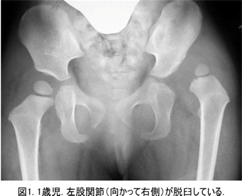 公益財団法人股関節研究振興財団 | 赤ちゃんの股関節脱臼に ...
