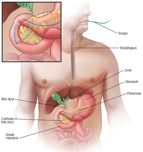 In pancreatic cancer, there may be bleeding internally from the stomach or around the pancreas, and people can sometimes vomit blood. Pancreatic Cancer - Causes, Symptoms, Signs, Survival Rate ...