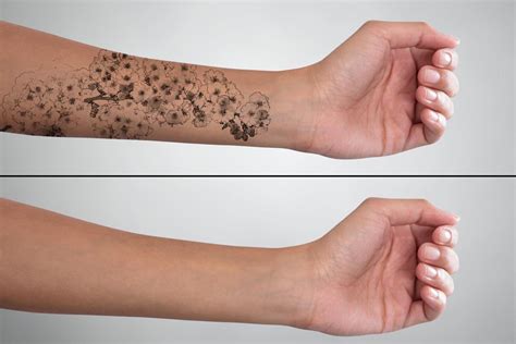 Tattoos can be removed using several different methods: Laser Tattoo Removal: How Long Does the Process Take ...