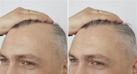 However, a deficiency is rare. How to Use Biotin for Hair Growth - Bald & Beards