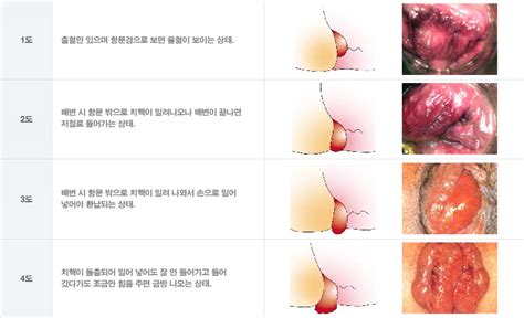 외치핵은 항문 주변의 직장 조직 외부에 발생하는 치핵을 의미한다. 항문클리닉-치핵 | 계양장문외과