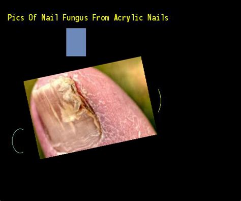 Acrylic nails and fungus nail ideas nail photo gallery. Pics of nail fungus from acrylic nails - Nail Fungus ...