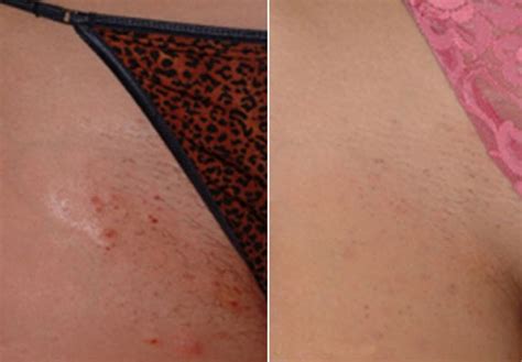 The only permanent hair removal is electrolysis. Laser Hair Removal Before & After Gallery