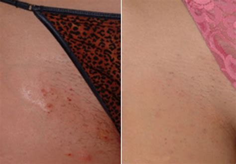 In this video i am going to teach you how to do brazilian wax at home by yourself , easy and step by. Laser Hair Removal Before & After Gallery