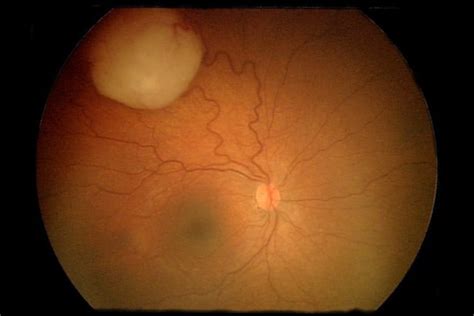 Cancer that occurs in eye tissue is called eye cancer. Therapy using immune system cells preserves vision in mice ...