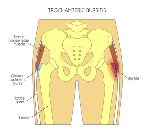 Tendons attach the muscles to each other. 9 Best Exercises For Hip Bursitis | Best exercise for hips ...