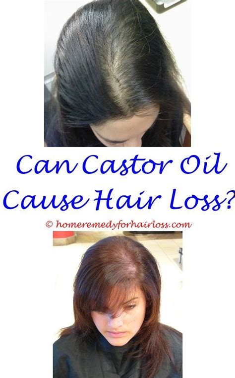 Biotin probably does not cause hair loss. can too much cortisol cause hair loss - hair loss taking ...