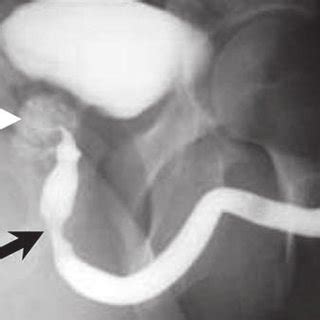 Image from ascending urethrography shows an area of ...