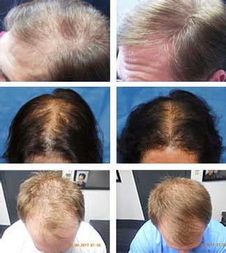 Hair loss occurs when stress, genetics, or hormones keep hair follicles from supporting a healthy hair growth cycle. Laser Treatments for Hair Loss | Laser Hair Therapy CT