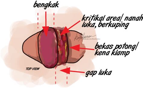 Selain majlis perkahwinan, majlis bersunat juga merupakan antara perkara yang akan dilakukan apabila tiba musim cuti. Cara Hilangkan Bengkak Selepas Bersunat