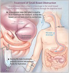 My grandfather was diagnosed with a bowel obstruction is too sick to operate on they put him on comfort measures and sent him to the nursing home a dr? bowel obstruction nursing diagnosis. Rosh Review - ogilvie syndrome - acute colonic pseudo ...