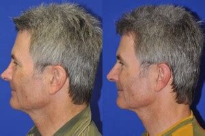 closed-reduction-nasal-fracture-7 - Mehta Plastic Surgery