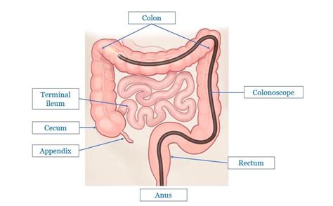 You have been directly referred for a colonoscopy by your physician. Colonoscopy Preparation #3 PICOPREP® - Maher A. Abbas ...