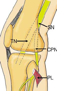 Local anesthetic spread surrounding the sciatic nerve within the vloka's sheath. Schematic diagram of the course of the common peroneal ...