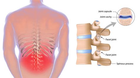 So what is low back strain? 5 Stretches to Help Prevent and Relieve Lower Back Pain