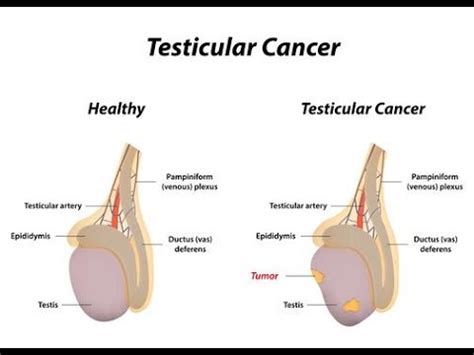 What is the treatment for cryptorchidism? What Can Cause Testicular Cancer? - (What Caused Mine ...