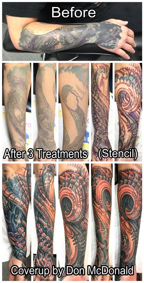 So, before getting a tattoo done, think over and choose the right one. Before & After — Disappearing Ink Laser Tattoo Removal
