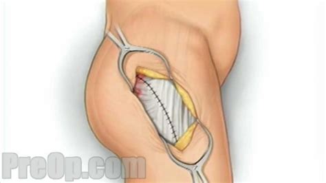 Last updated may 24, 2019by howard j. Hip Replacement Surgery - PreOp Patient Education Medical ...