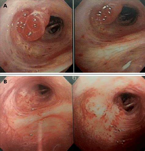 § peptic ulcers do not typically develop in patients with. A. tumor carcinoide en bronquio intermediario. B. tres ...