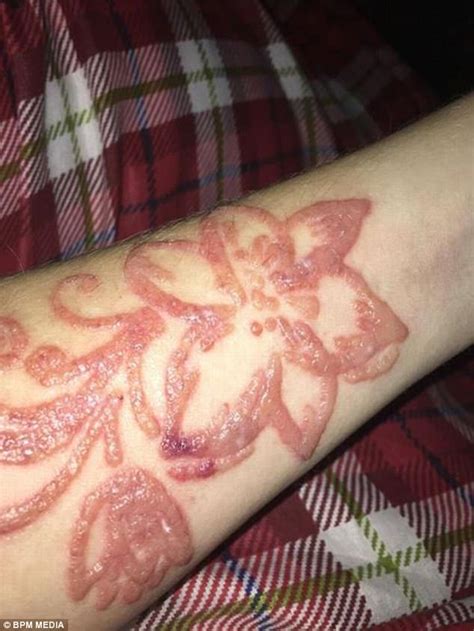 It can cause severe reactions and permanent scarring. Brit left with scar from black henna tattoo in Bulgaria ...