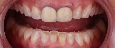 Achieving natural esthetics during full mouth rehabilitation is possible with modern all ceramic restorations. Full Mouth Rehabilitation | Miguel Robles | Prosthocontest2019
