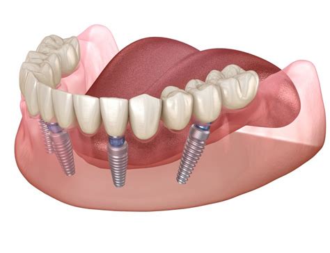 Dental implants are a form of highly important dental treatment. All-on-4 Dental Implants Frisco | Teeth in a Day | Ten Mile Dental