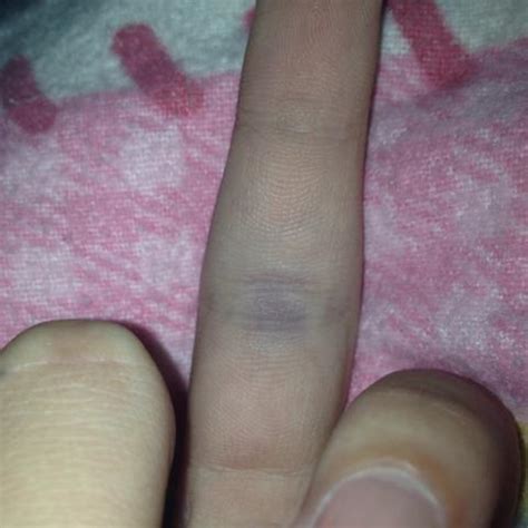 Einklemmen des fingers ist die häufigste ursache für eine fraktur. Gebrochen der Mittelfinger (Knochen)