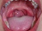 Laryngeal cancer is cancer of the larynx, an organ in the front of the neck between the esophagus. Throat Cancer. Causes, symptoms, treatment Throat Cancer