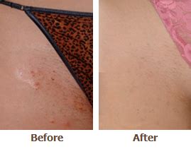 How much does laser hair removal cost in st. Permanent Laser Hair Removal in Minneapolis-St. Paul ...