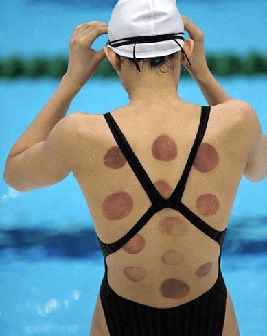 Cupping is a therapy used in traditional chinese medicine (tcm) to remove stagnation and stimulate the flow of qi (chi). Chinese Medicine and Sports Injury Rehabilitation | SportsEdTV