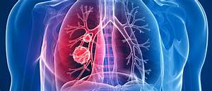 Lung cancer diagnoses via A&E are a ‘travesty’ says new report - Roy Castle Lung Cancer Foundation Lung Cancer  