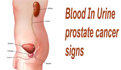 Men who are 50 or older have a higher risk of prostate cancer. Early Warning Signs of Prostate Cancer