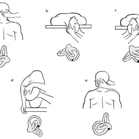 These movements bring the crystals back to the utricle, where they belong. Epley Maneuver for right-sided posterior semicircular ...