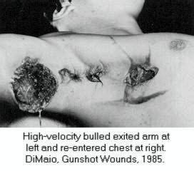 It has remained in use since as one of the. 50 Caliber Bullet Wound