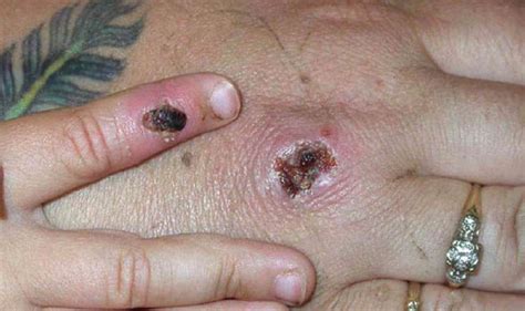 Jun 10, 2021 · the uk is dealing with an outbreak of monkeypox, health secretary matt hancock casually told mps today. Third case of monkeypox hits England | UK | News | Express ...