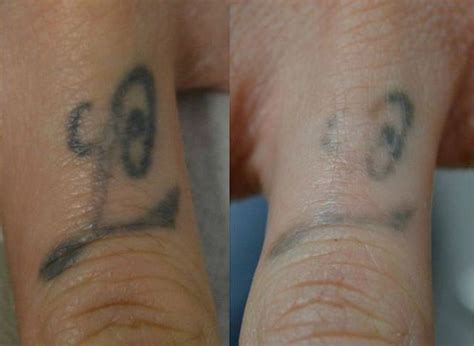 The price is dependent on several factors, including the type and extent of the tattoo, and. Finger tattoo after 1 session ‪#‎lasertattooremoval ...