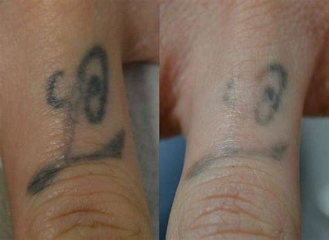 Laser tattoo removal is a complex process that a technician must evaluate on an. Finger tattoo after 1 session ‪#‎lasertattooremoval ...