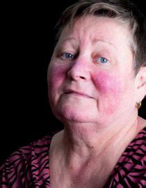 We did not find results for: Lupus Rash: Understanding and Coping With Lupus Skin Rashes