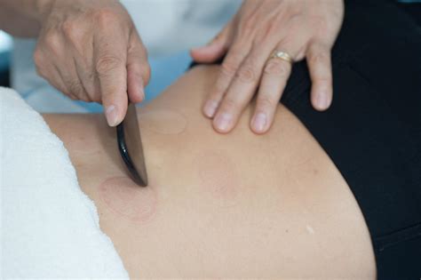 Gua sha in the chinese is 刮痧 (pronounced as gwah shah). Gua sha Therapy Sydney | Acupuncture And Beauty Centre