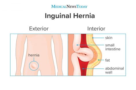 The lump could appear as one or in a group. Inguinal hernia: Surgery, symptoms, and causes