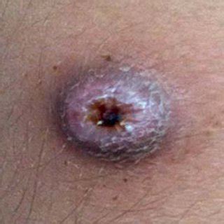 Leishmanin test for post kala azar dermal leishmaniasis. Montenegro skin test: intradermal application of a ...