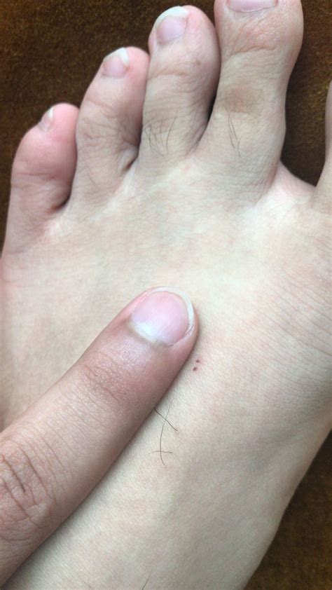 You should be prepared to describe the spider, where and when the bite took place, and what you were doing at the time. My husband woke up with a two puncture wound, 2mm big ...