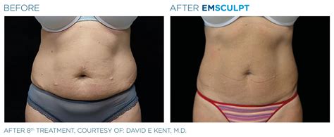 Before going to france, you should read the guide book. EMSCULPT BEFORE AND AFTER | REAL PATIENT RESULTS - Skinney ...