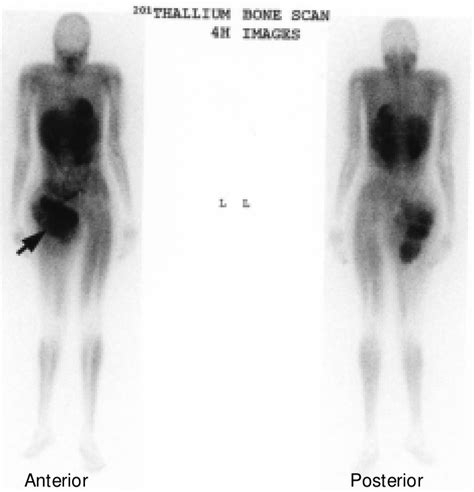 The respective electronic configuration of thallium is xe 4f14 5d10 6s2 6p1. Whole body thallium 201 scintigraphy at 4 hours shows ...