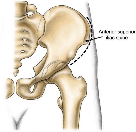 The anterior superior iliac spine is an important bony surface landmark and is the prominence is the most anterior part of the ilium. Anterior Superior Iliac Spine (ASIS) | 척추측만증