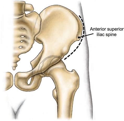 Jul 27, 2021 · its superior aperture faces towards the thorax, enclosed by the diaphragm. Anterior Superior Iliac Spine | 척추측만증