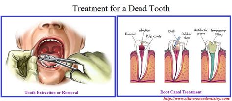 Rinse your mouth with salt water to reduce the risk of infection. Signs of A Dead (Non Vital) Tooth | St. Lawrence Dentistry