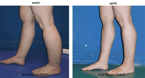 Les mollets sont difficiles à cacher, c'est une partie du corps qui reste visible, quoi que vous fassiez. Liposuccion des mollets pour affiner les jambes