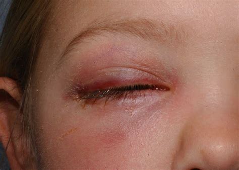 Periorbital cellulitis or preseptal cellulitis (not to be confused with orbital cellulitis, which is posterior to the orbital septum), is an inflammation and infection of the eyelid and portions of skin around the. Periorbital cellulitis, Orbital cellulitis, causes ...